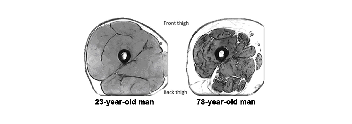 Sarcopenia