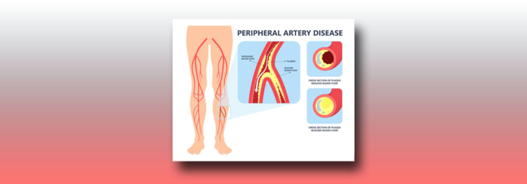 exercise-for-peripheral-artery-disease-drchet