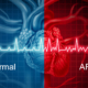 Atrial Fibrillation