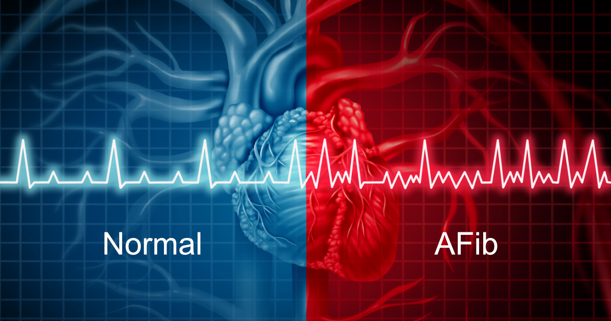 Atrial Fibrillation